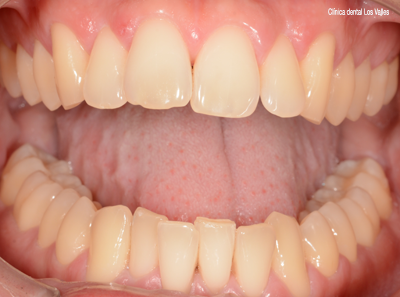 ortodoncia-invisalign-lite3