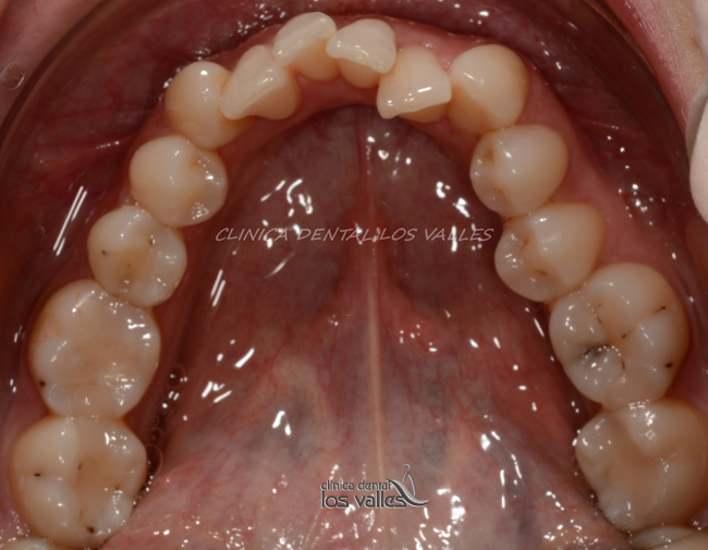 Con un sistema que pasa totalmente inadvertido, la Ortodoncia Lingual Incognito es un tratamiento perfecto y estético para tratar la mordida cruzada y el apiñamiento.