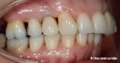 ventajas-implantes-dentales